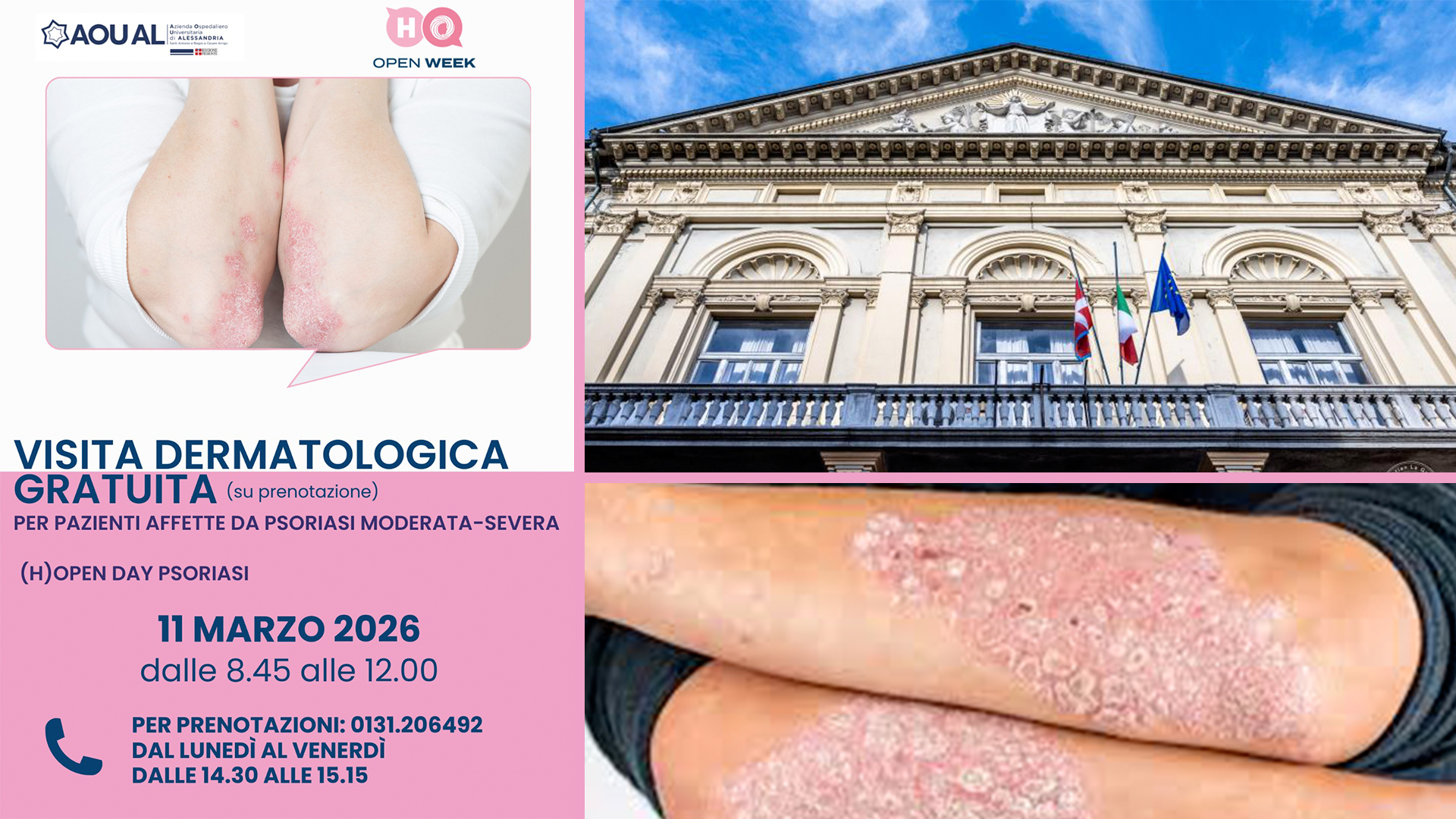 Alessandria. Open Day Psoriasi: l’11 marzo visite dermatologiche gratuite all’AOU AL